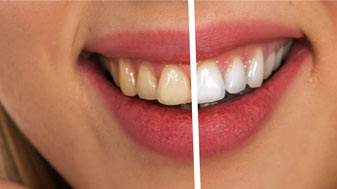 Teeth Whitening South Hedland