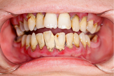 Wisdom Teeth Removal Paraburdoo