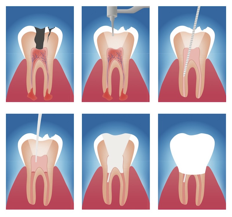 Root Canal Treatment Paraburdoo