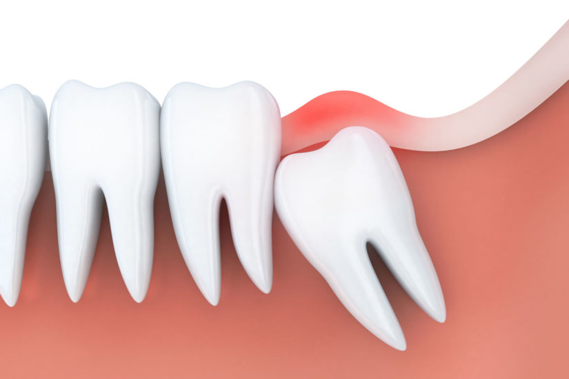 Wisdom Teeth Removal Paraburdoo